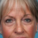 Upper Blepharoplasty Before & After Patient #4667