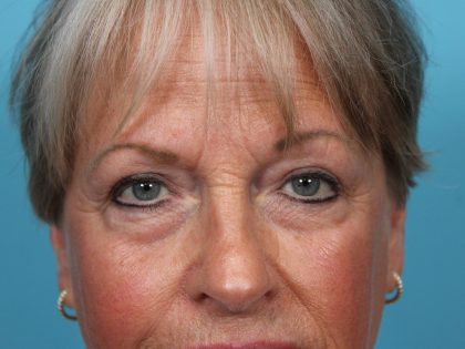 Upper Blepharoplasty Before & After Patient #4667