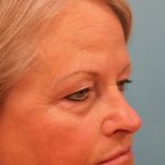Upper Blepharoplasty Before & After Patient #4667