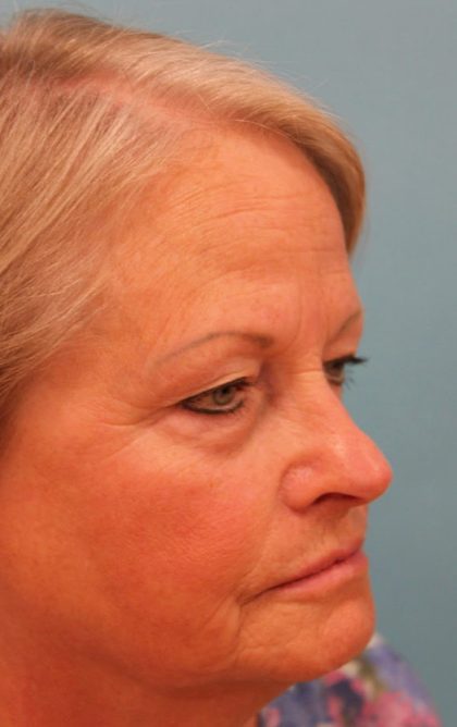 Upper Blepharoplasty Before & After Patient #4667