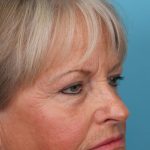 Upper Blepharoplasty Before & After Patient #4667