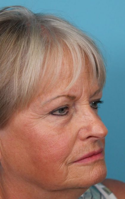Upper Blepharoplasty Before & After Patient #4667