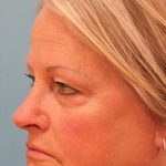 Upper Blepharoplasty Before & After Patient #4667