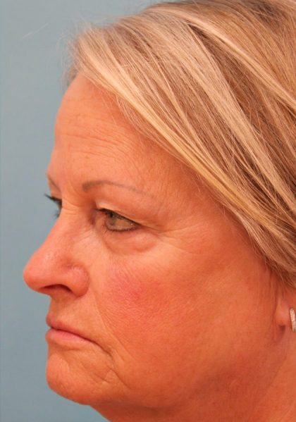Upper Blepharoplasty Before & After Patient #4667