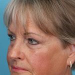 Upper Blepharoplasty Before & After Patient #4667