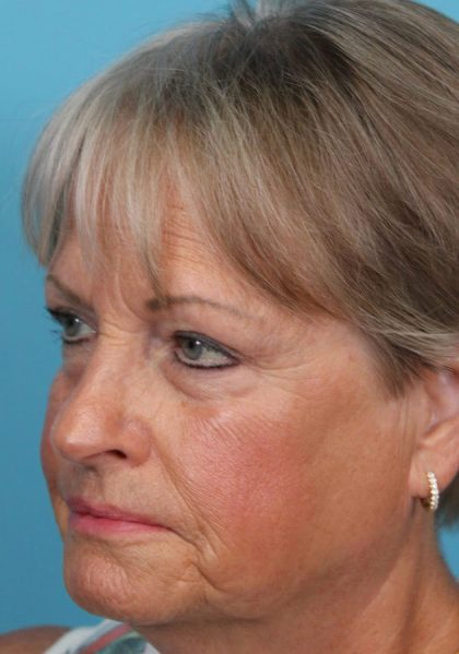 Upper Blepharoplasty Before & After Patient #4667