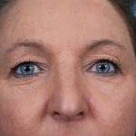 Upper Blepharoplasty Before & After Patient #4668
