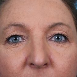 Upper Blepharoplasty Before & After Patient #4668
