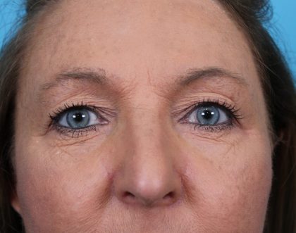 Upper Blepharoplasty Before & After Patient #4668