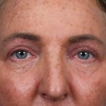 Upper Blepharoplasty Before & After Patient #4668