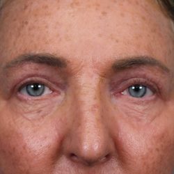 Upper Blepharoplasty Before & After Patient #4668