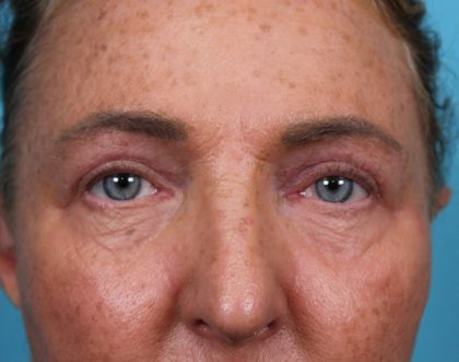 Upper Blepharoplasty Before & After Patient #4668