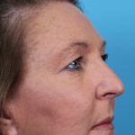 Upper Blepharoplasty Before & After Patient #4668