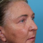 Upper Blepharoplasty Before & After Patient #4668