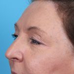 Upper Blepharoplasty Before & After Patient #4668