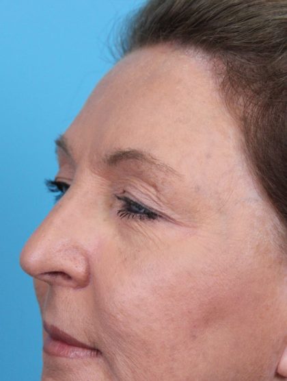 Upper Blepharoplasty Before & After Patient #4668