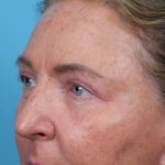 Upper Blepharoplasty Before & After Patient #4668