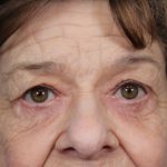 Upper Blepharoplasty Before & After Patient #4669