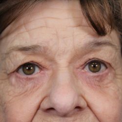 Upper Blepharoplasty Before & After Patient #4669