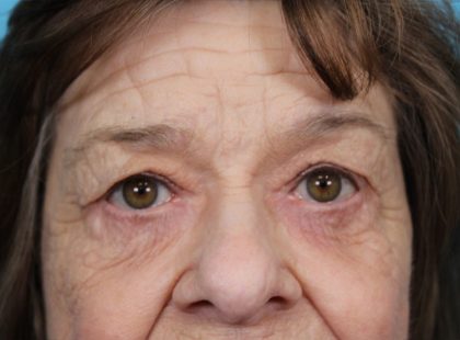 Upper Blepharoplasty Before & After Patient #4669