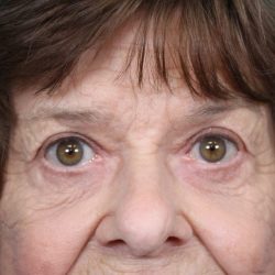 Upper Blepharoplasty Before & After Patient #4669