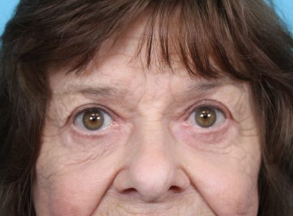 Upper Blepharoplasty Before & After Patient #4669