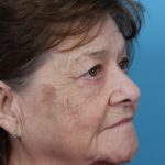 Upper Blepharoplasty Before & After Patient #4669