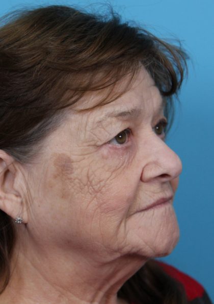 Upper Blepharoplasty Before & After Patient #4669