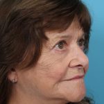 Upper Blepharoplasty Before & After Patient #4669