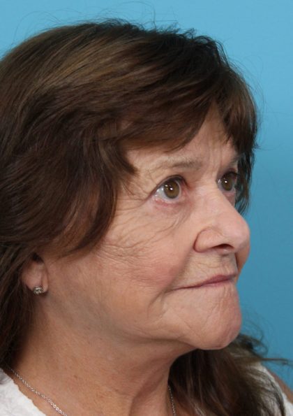 Upper Blepharoplasty Before & After Patient #4669