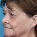 Upper Blepharoplasty Before & After Patient #4669
