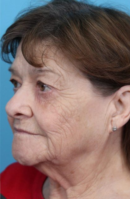Upper Blepharoplasty Before & After Patient #4669