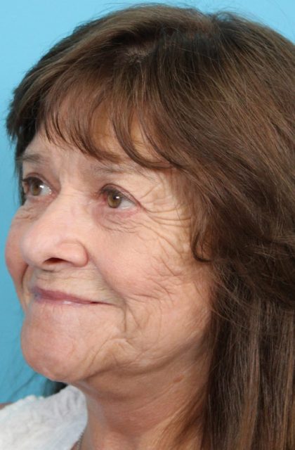 Upper Blepharoplasty Before & After Patient #4669