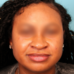 Submental Liposuction Before & After Patient #4789