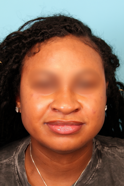 Submental Liposuction Before & After Patient #4789