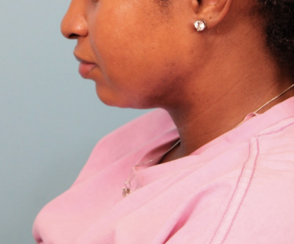 Submental Liposuction Before & After Patient #4789