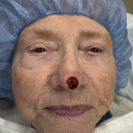 Mohs Surgery Before & After Patient #4786
