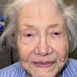 Mohs Surgery Before & After Patient #4786