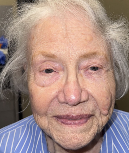 Mohs Surgery Before & After Patient #4786