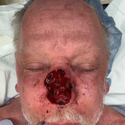 Mohs Surgery Before & After Patient #4826