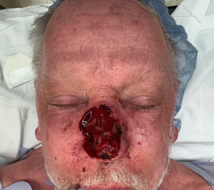 Mohs Surgery Before & After Patient #4826