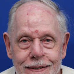 Mohs Surgery Before & After Patient #4826