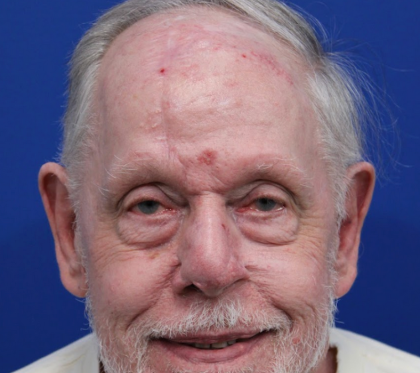 Mohs Surgery Before & After Patient #4826