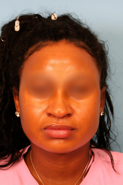 Buccal Fat Reduction Before & After Patient #4801