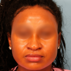 Submental Liposuction Before & After Patient #4789