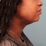 Submental Liposuction Before & After Patient #4789