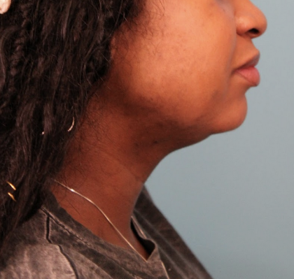 Submental Liposuction Before & After Patient #4789