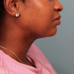 Submental Liposuction Before & After Patient #4789