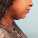 Submental Liposuction Before & After Patient #4789