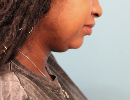 Submental Liposuction Before & After Patient #4789